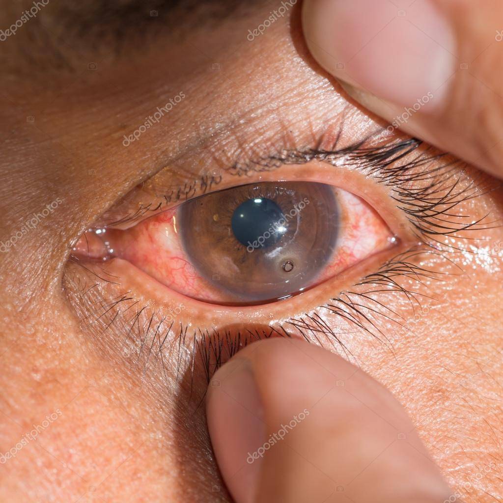 Болят глаза после линз: почему вы стали это ощущать, когда надеваете контактные корректоры, а также при ношении и снятии цветных, и что делать для устранения причин?