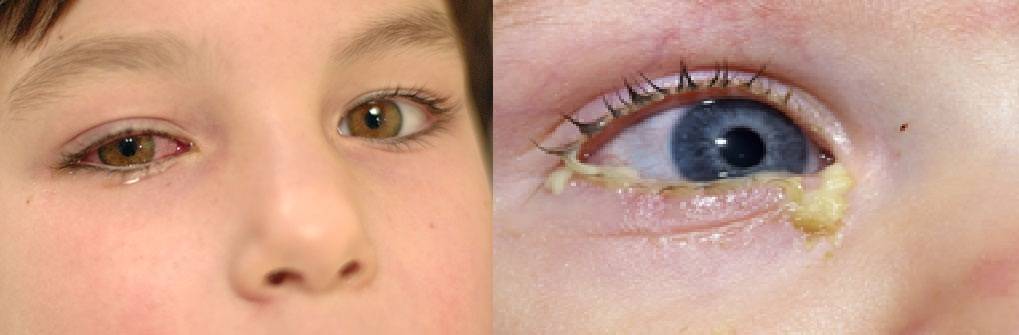 Гнойный коньюктивит глаз: лечение у детей, чем лечить у ребенка?