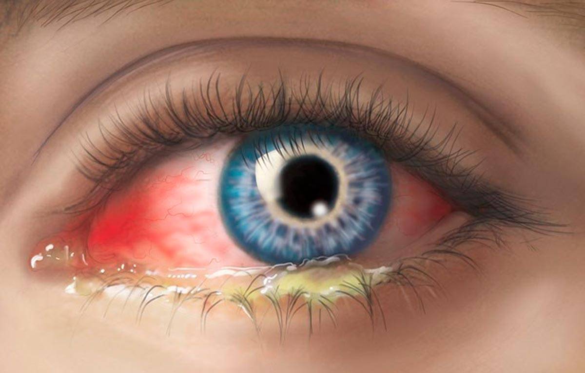Хронический конъюнктивит глаз: лечение у взрослых, симптомы, причины возникновения, диагностика, профилактика, капли и таблетки