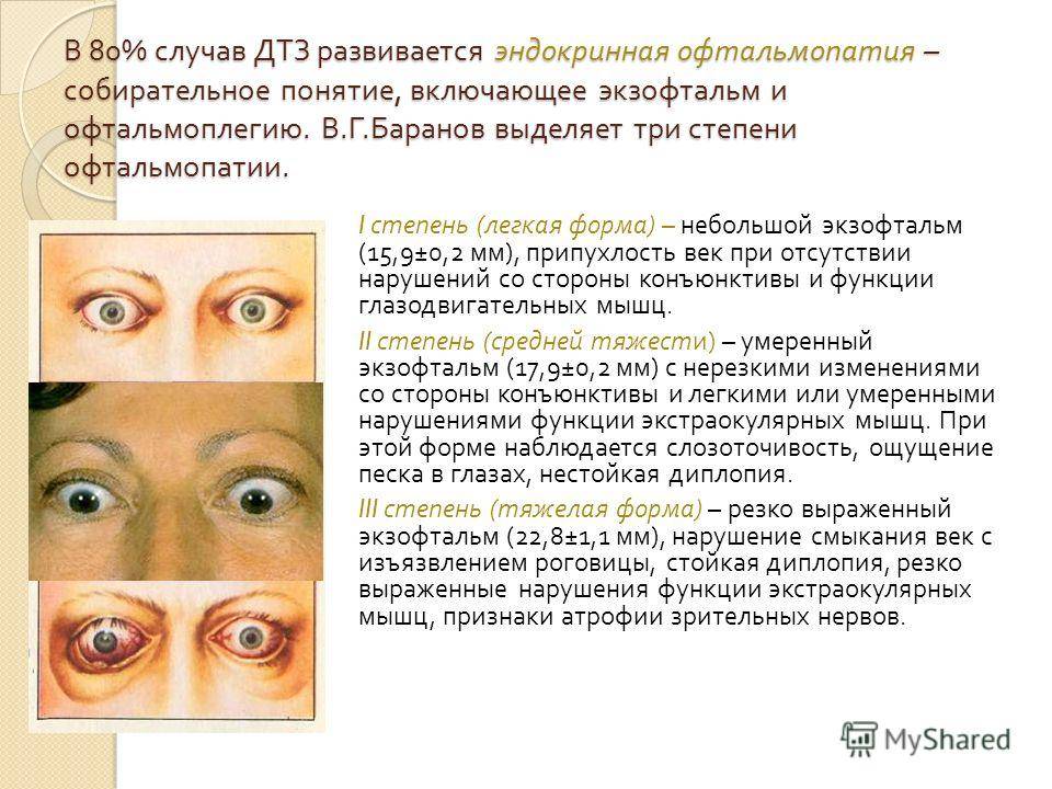 Серьезная патология мышечных тканей глаза – офтальмоплегия