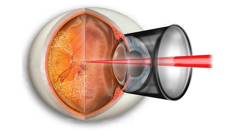 Лазерокоагуляция сетчатки глаза - лазерное прижигание: профилактическое периферическое, ограничительное лазером