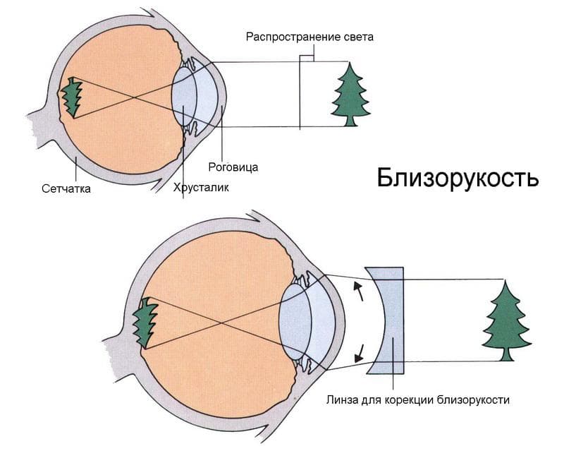 Что значит зрение минус 2: восстановление остроты глаз при близорукости