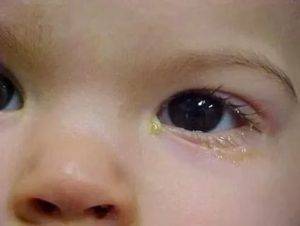 Воспаление глаза у ребенка: чем лечить, если воспалился, что делать, методы лечения