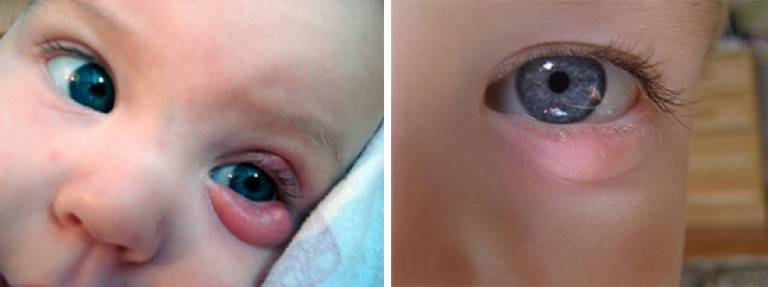 Выделения из глаз у новорожденного: причины нагноения глаз у новорожденных (видео)