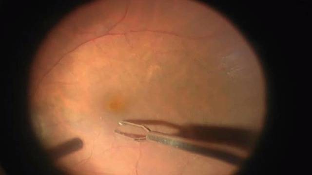 Отслоение сетчатки глаза с разрывом – причины развития и лечение — глаза эксперт