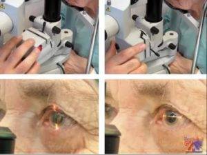 Послеоперационный период после замены хрусталика глаза при катаракте oculistic.ru
послеоперационный период после замены хрусталика глаза при катаракте