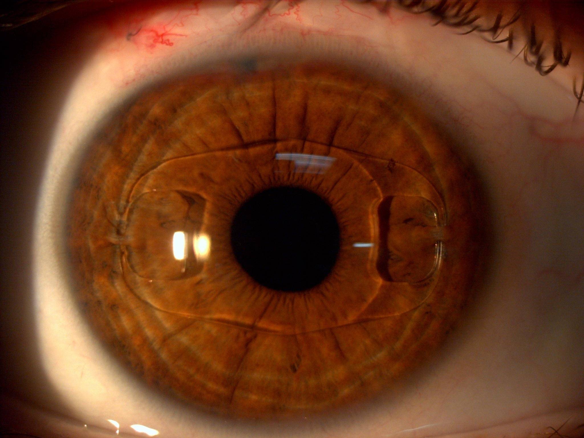 Кросслинкинг роговицы глаза: описание, ход операции, возможные осложнения и восстановление