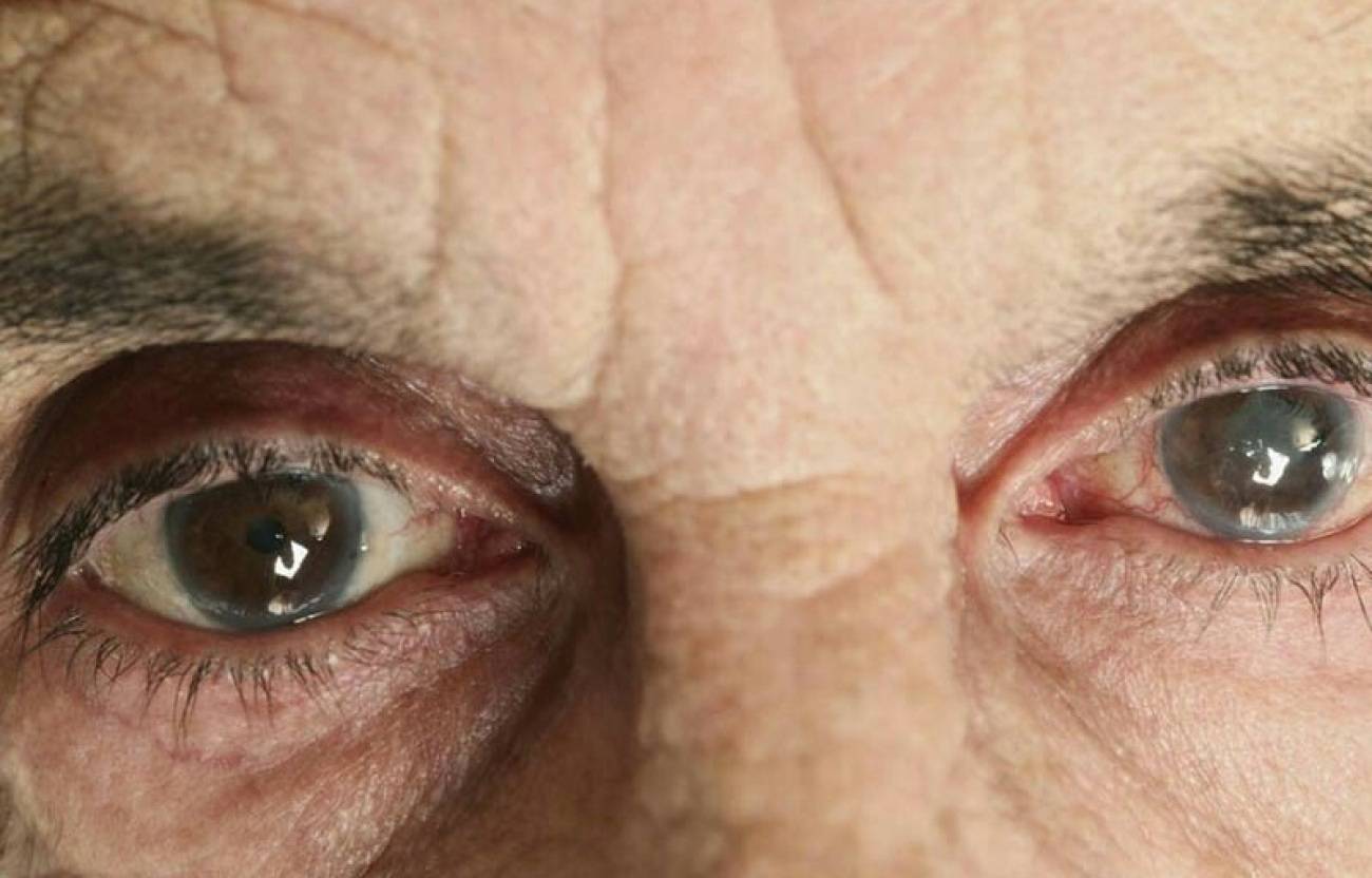 Лечение катаракты у пожилых людей, операция и методы без неё, цены