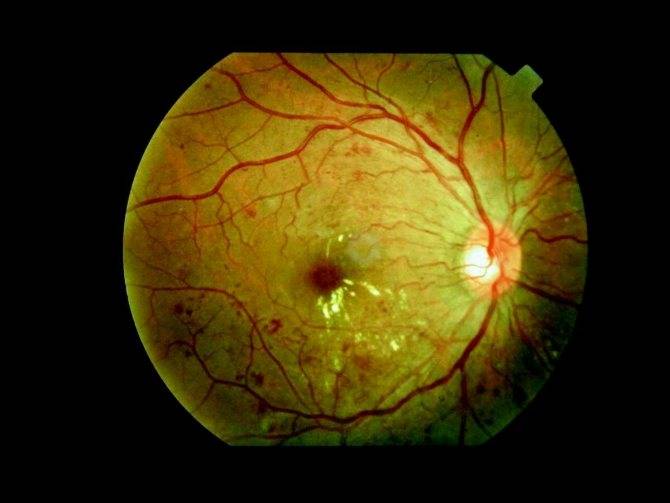 Ангиопатия сетчатки глаз: как устранить болезнь и сохранить зрение?