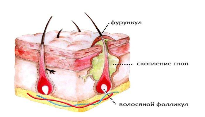Чирей на глазу и брови: как быстро вылечить фурункул