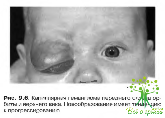 Методы лечения гемангиомы глаза, рекомендации врачей для детей и взрослых