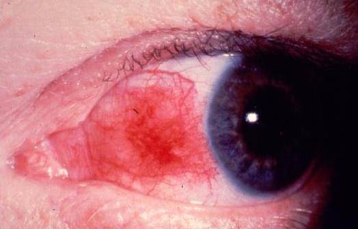 Блефарит глаз: фото, симптомы, лечение у взрослых и детей