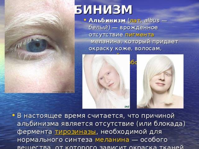 Дети-альбиносы. в чём причина и как проявляется заболевание?