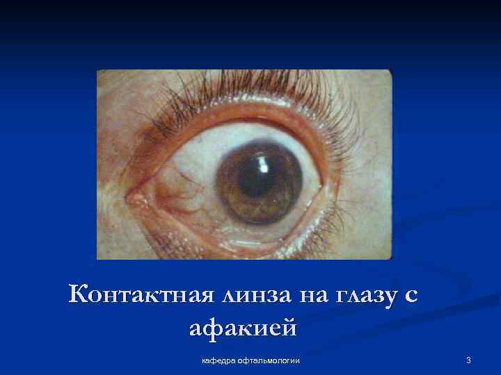 Афакия глаза (отсутствие хрусталика в глазу): что это такое, признаки, методы коррекции и другие аспекты