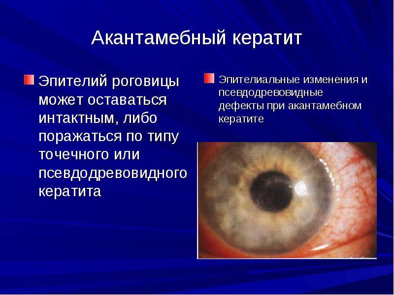 Кератит глаза