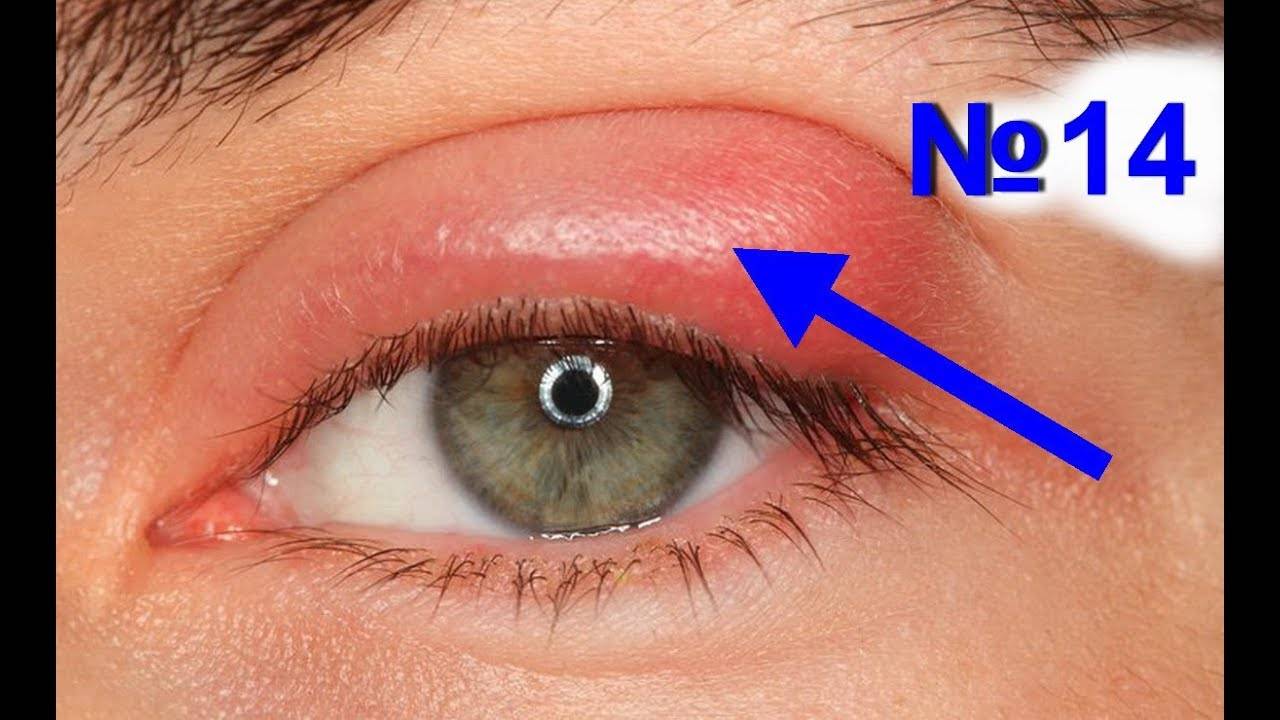 Ячмень на глазу – причины, симптомы и лечение в домашних условиях