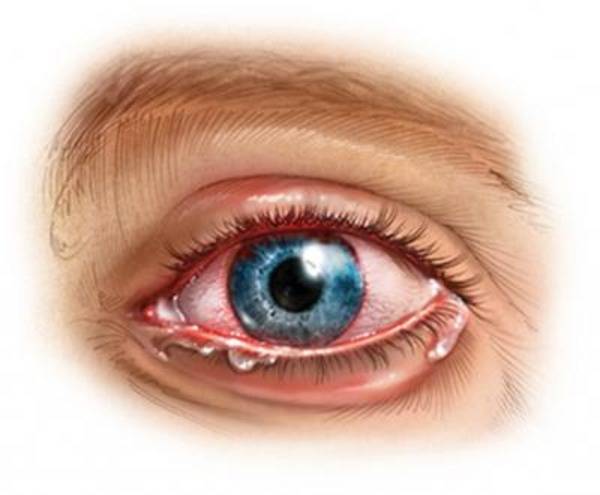 Что такое ирит (воспаление радужки глаза) и как его вылечить