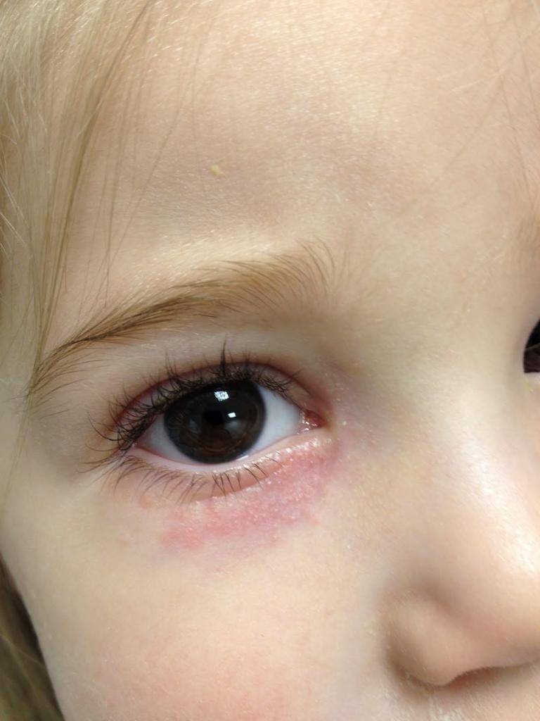 Красные круги под глазами у ребенка: причины, методы лечения