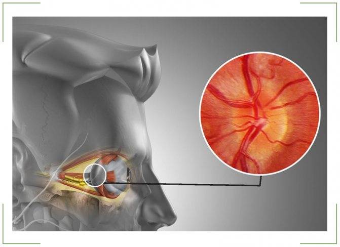 Последствия глаукомы: атрофия зрительного нерва, трубчатое зрение