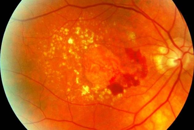 Дистрофия сетчатки глаза - симптомы, диагностика и лечение