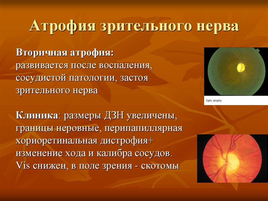 Атрофия зрительного нерва | симптомы и лечение атрофии зрительного нерва | компетентно о здоровье на ilive