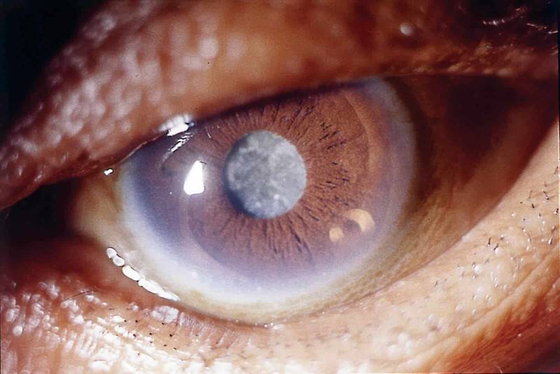 Незрелая катаракта: лечение возрастной (старческой) патологии, причины, симптомы