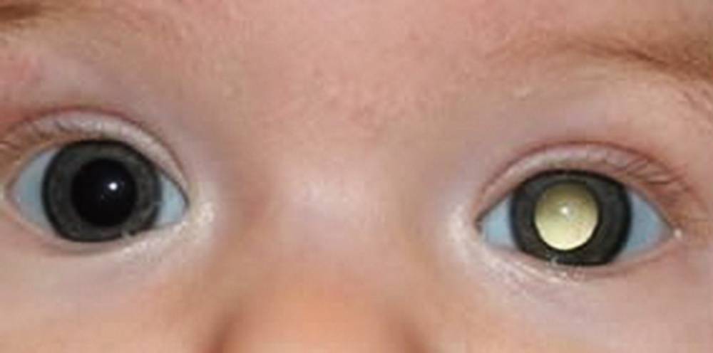 Ретинобластома глаз у детей
