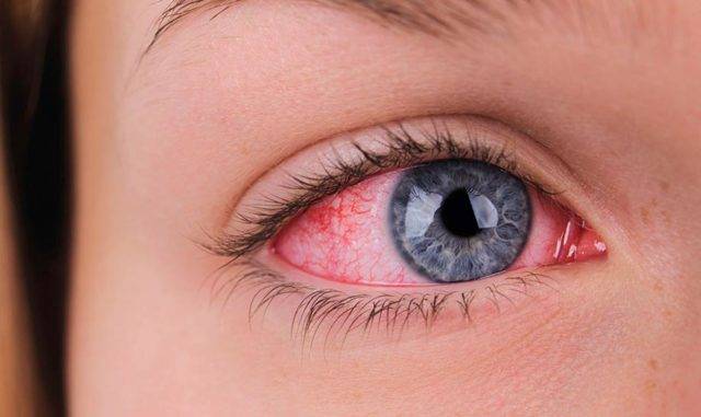 Почему белки глаз красные