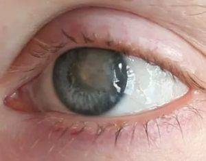 Мутные глаза у человека: причины, лечение oculistic.ru
мутные глаза у человека: причины, лечение