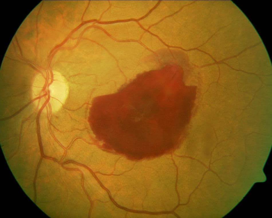 Что такое эпиретинальный фиброз глаз. народные рецепты для лечение фиброза сетчатки глаза