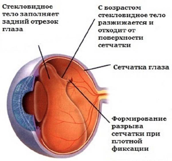 Разрыв сетчатки глаза: причины, лечение, операция