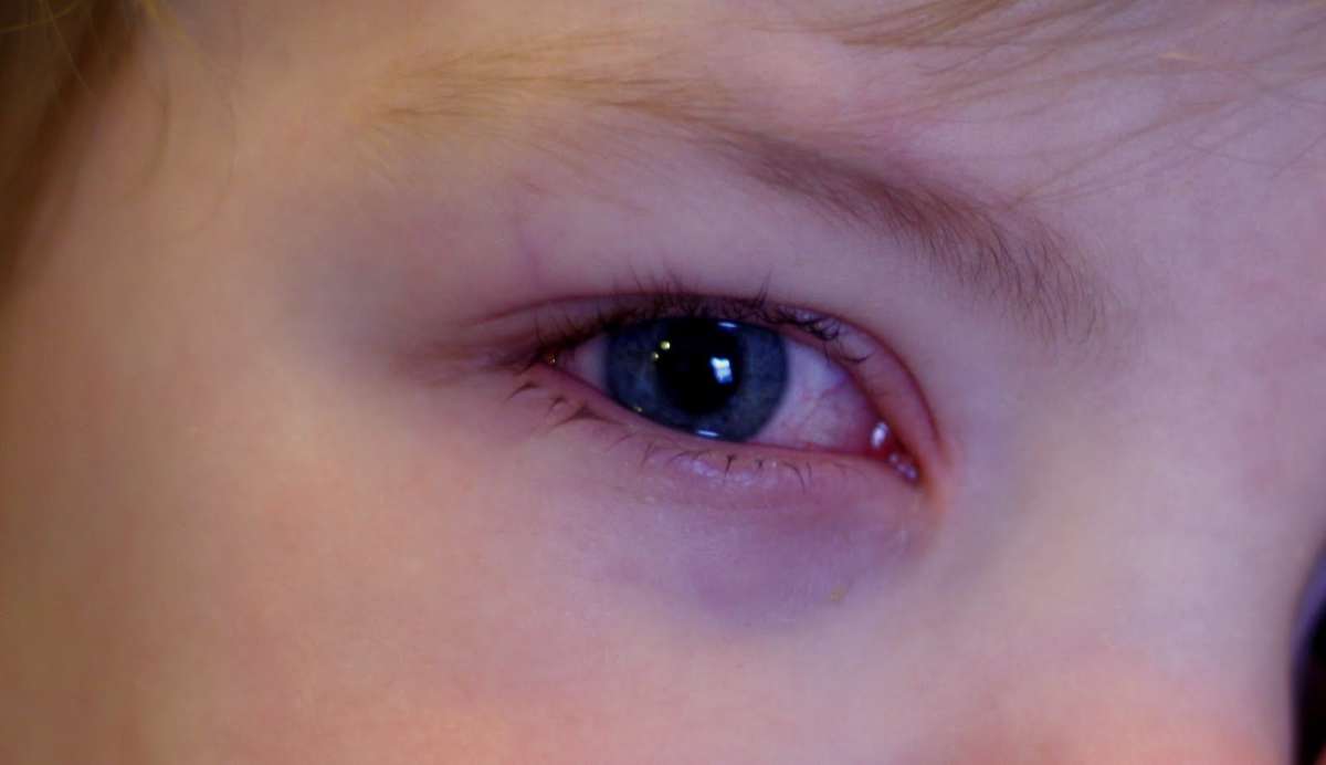 Почему у ребенка слезится глаз и что делать при появлении проблемы