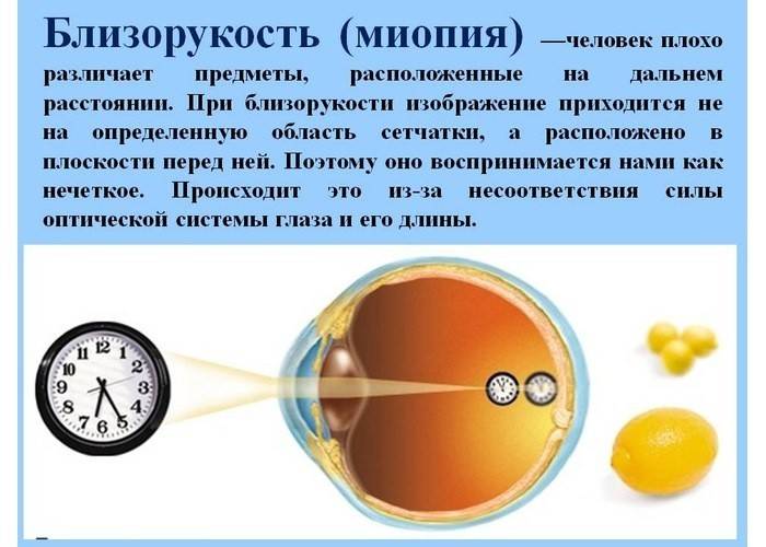 Восстановить зрение на 100% без операции
