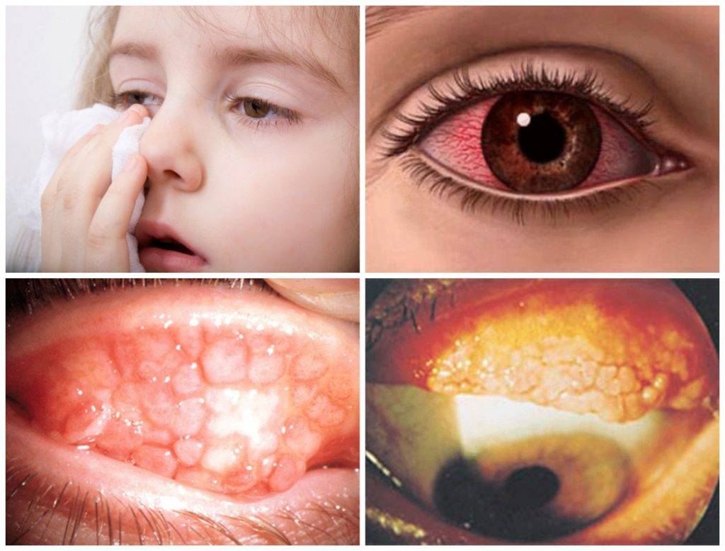 Светобоязнь глаз: причины у взрослого и ребенка, лечение боязни света, симптомы болезней, диагностика, профилактика фотофобии