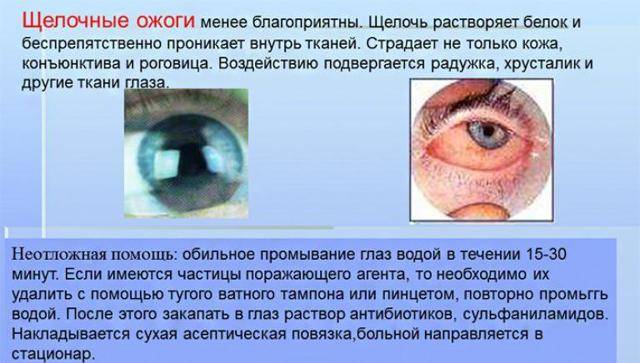 Химические ожоги глаз