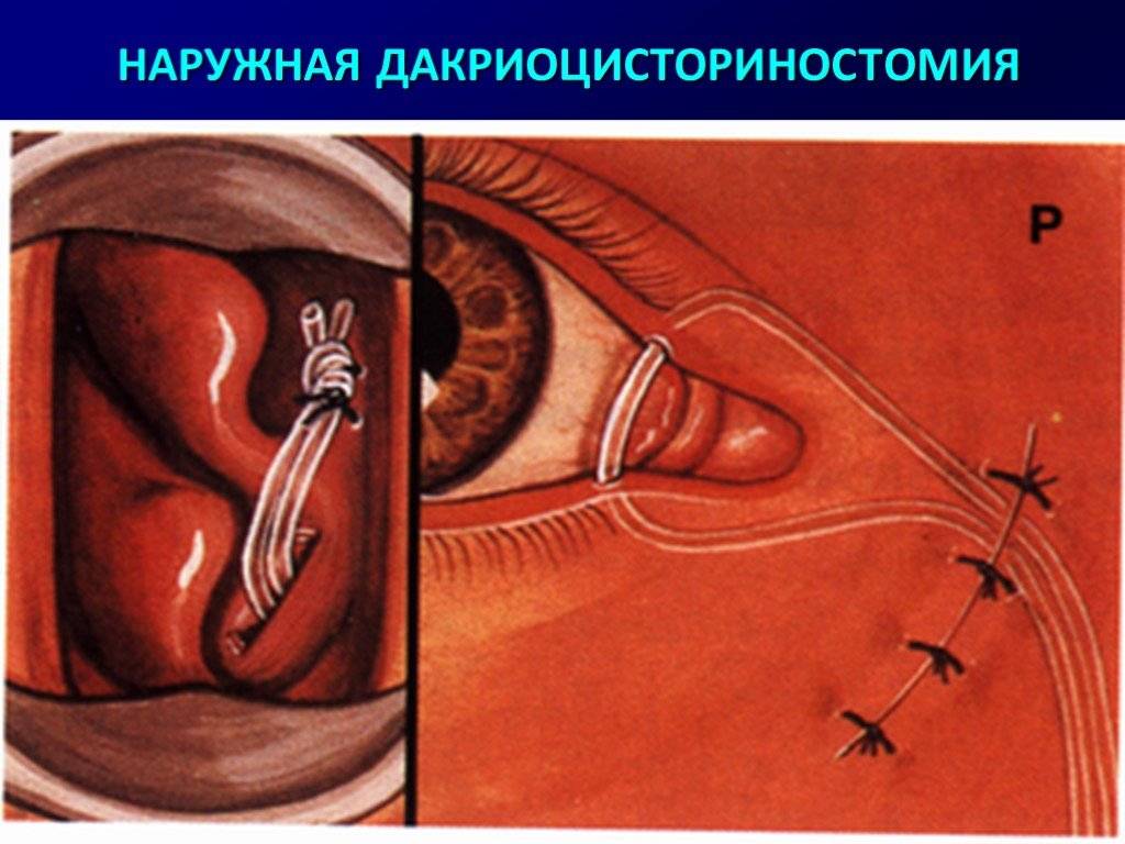 Дакриоцистит | мнтк «микрохирургия глаза» им. акад. с.н. федорова