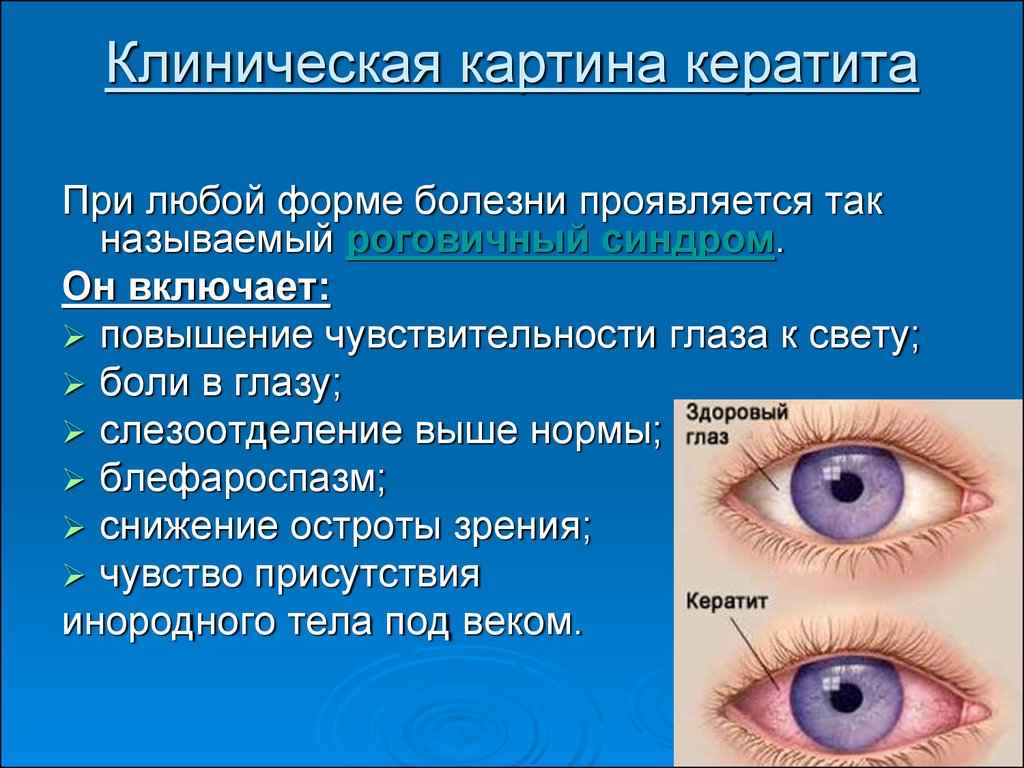 Язва роговицы глаза у человека: причины, симптомы, диагностика и лечение