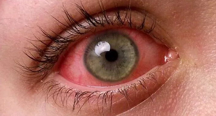 Красные глаза от компьютера - что делать и как снять неприятные симптомы
