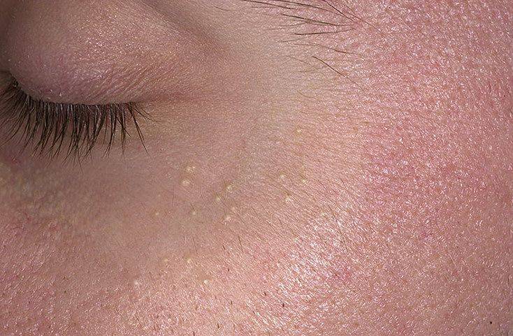 Милиумы на лице: причины появления просянки на веках глаз, симптомы, фото и как от них избавиться
