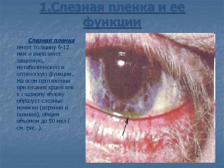 Сухой глаз. симптомы синдрома сухого глаза. причины сухости в глазах, диагностика и лечение патологии. какие капли капать при сухом глазе? :: polismed.com