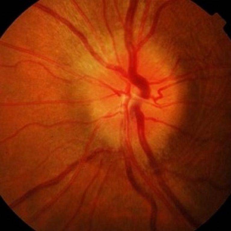 Застойный диск зрительного нерва: причины, симптомы и лечение