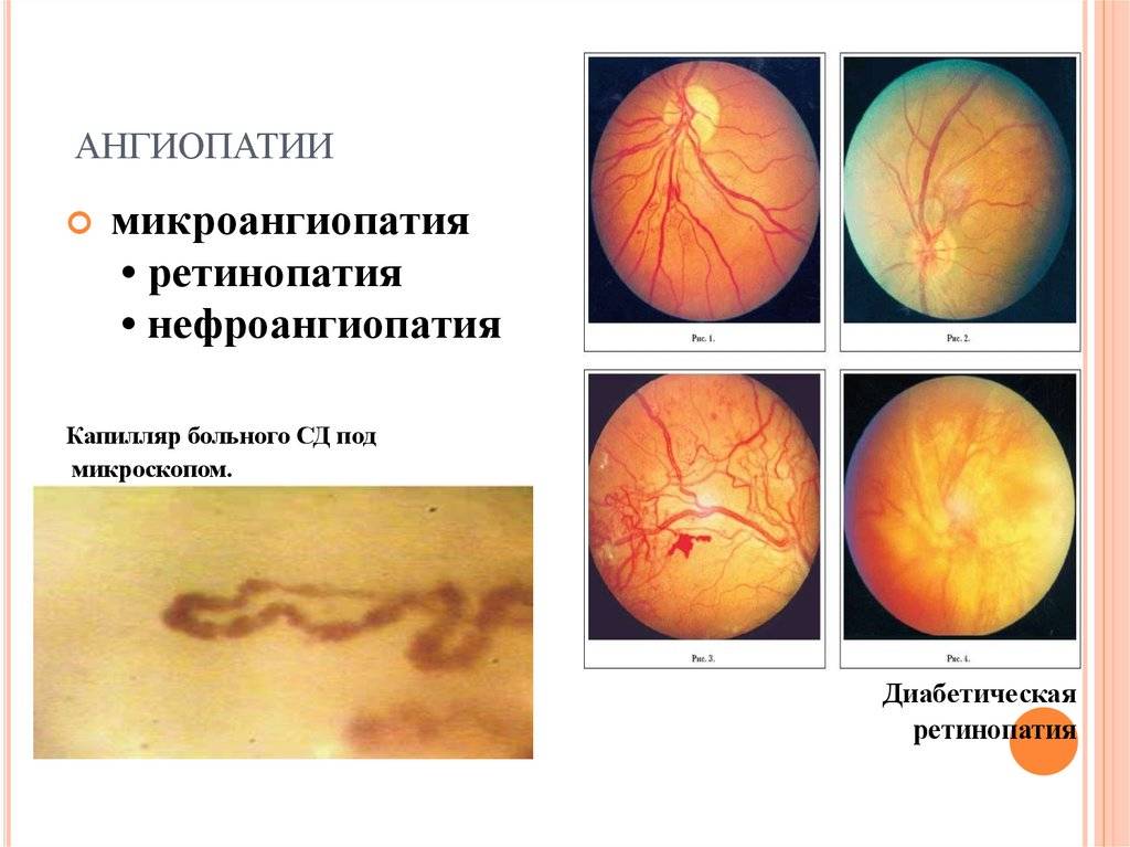 Ангиопатия сетчатки глаза у детей