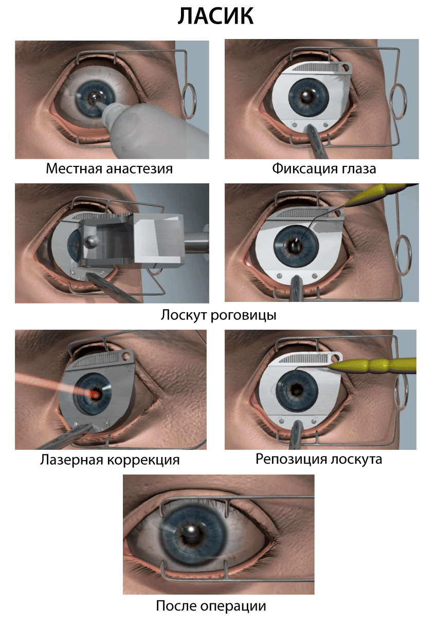 Восстановление зрения после лазерной коррекции - результаты