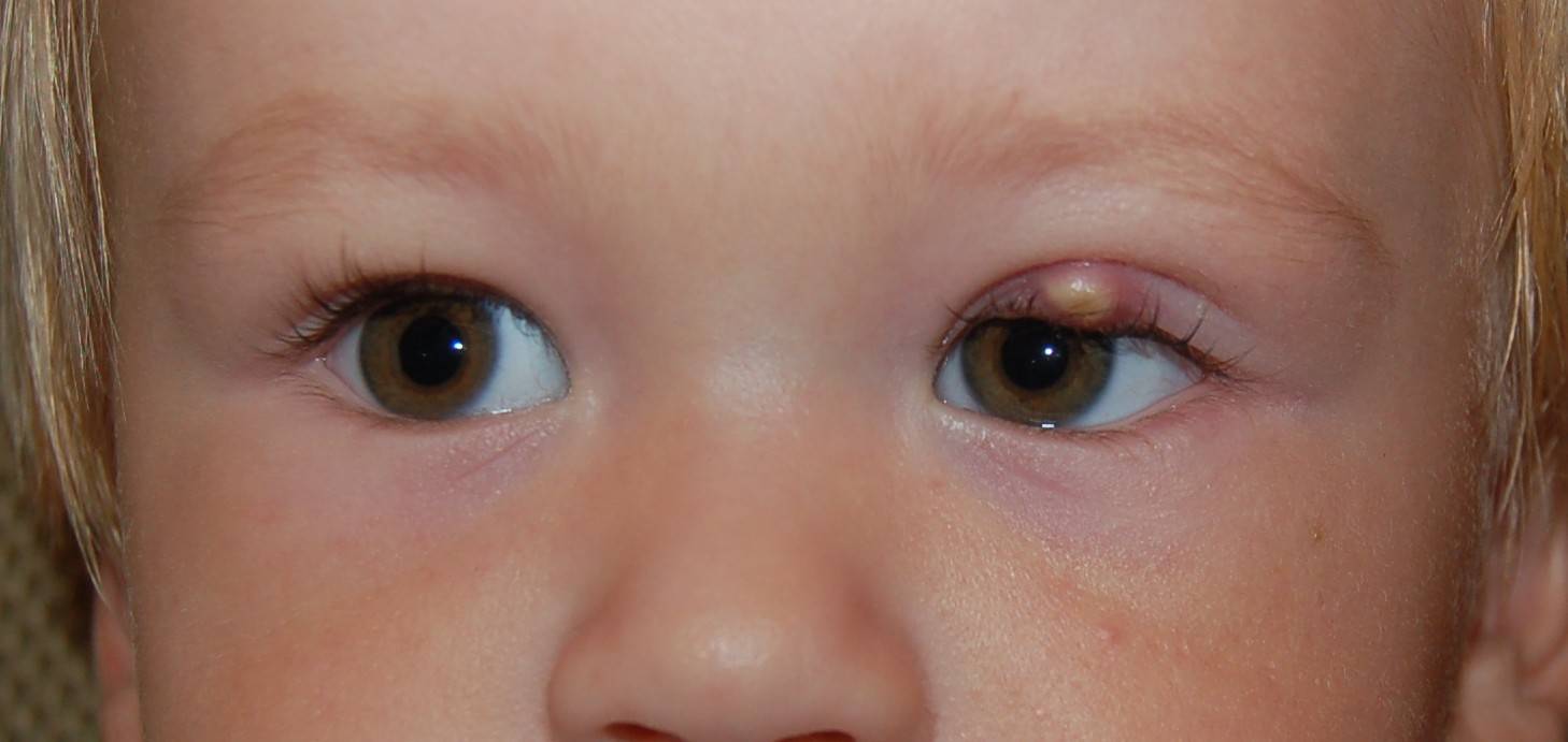 Отвечает офтальмолог: заразен ли ячмень на глазу для окружающих