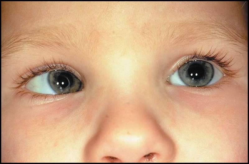 Пучеглазие (экзофтальм), выпученные глаза - причины, лечение