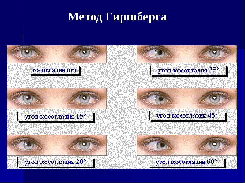 Виды зрения: классификация зрения у человека