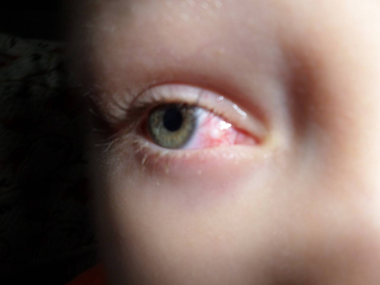 Царапина на роговице глаза - лечение народными средствами, первая помощь