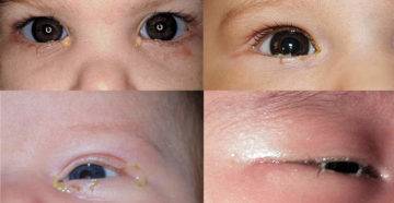 Закисают глаза у ребёнка: причины, лечение oculistic.ru
закисают глаза у ребёнка: причины, лечение