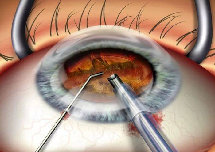Ограничения и противопоказания после лазерной коррекции зрения. сайт «московская офтальмология»