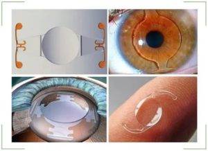 Какое показано лечение при вторичной катаракте после замены хрусталика